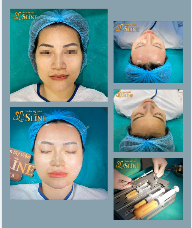 Trẻ hoá cả gương mặt với MỡTựThân