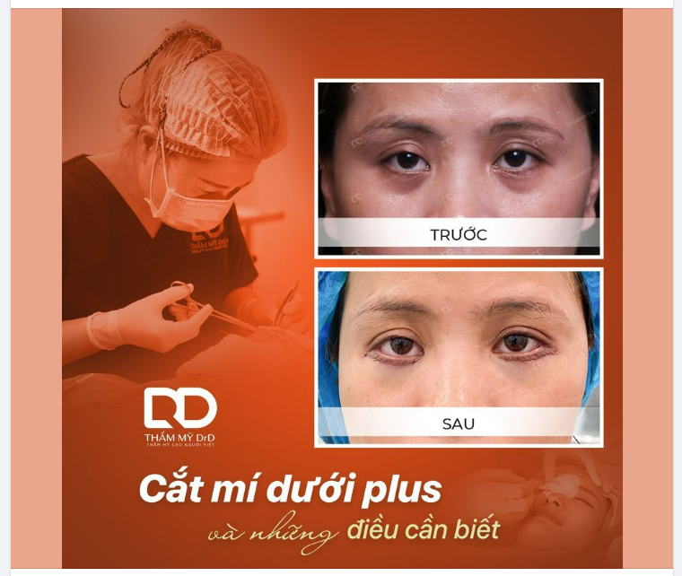 TRẺ RA 10 TUỔI NHỜ PHƯƠNG PHÁP CẮT MÍ DƯỚI PLUS