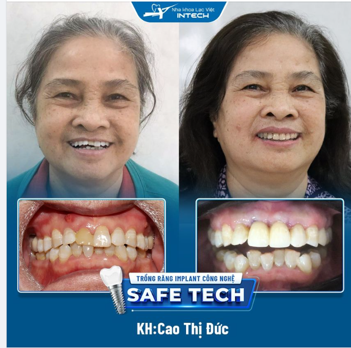 TRỒNG RĂNG CỬA BẰNG PHƯƠNG PHÁP CẤY GHÉP IMPLANT, AN TOÀN – THẨM MỸ