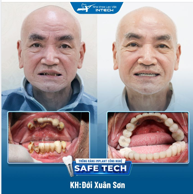 TRỒNG RĂNG IMPLANT ALL ON 4 – PHỤC HÌNH MẤT RĂNG TOÀN HÀM DƯỚI
