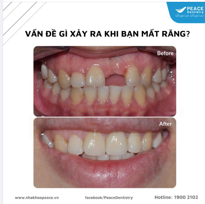 TRỒNG RĂNG IMPLANT GIẢI PHÁP TỐI ƯU CHO NGƯỜI MẤT RĂNG 