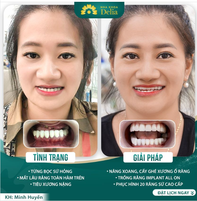Trổng răng Implant, phục hình răng sứ - Ăn nhai thoải mái, bền chắc dài lâu