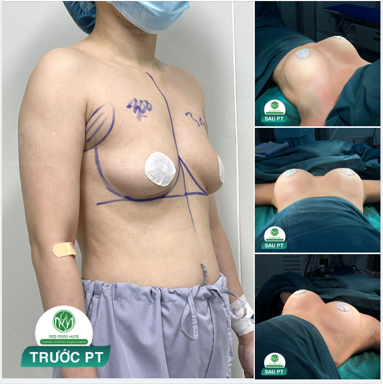 TRÙNG TU VÒNG 1 - NGỰC CĂNG TRÒN NGAY SAU THỰC HIỆN