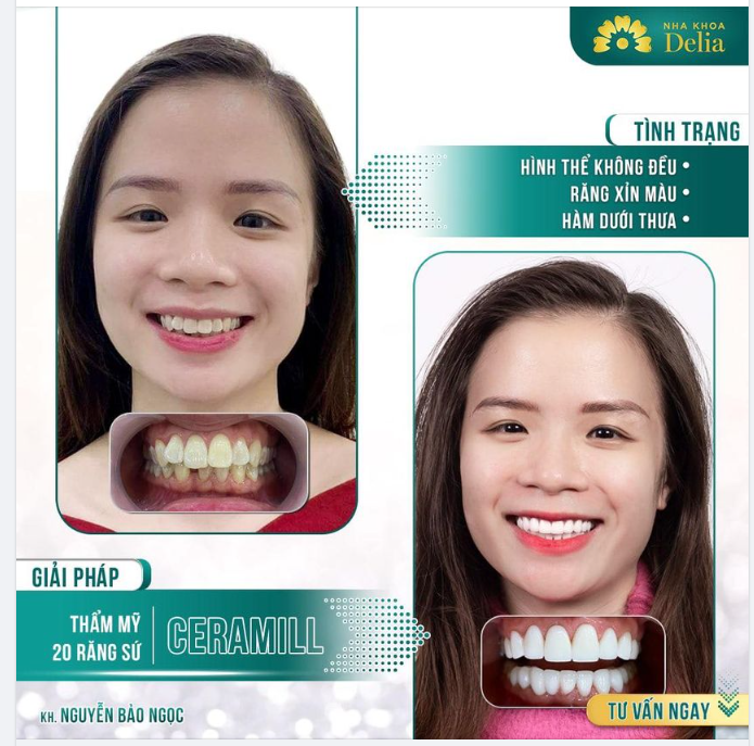 Trước khi đến với Delia, chị Bảo Ngọc chia sẻ nỗi tự ti răng khấp khểnh và lợi yếu, hay viêm sưng đỏ. Nhưng chị vẫn còn nỗi lo sợ đau, và còn phân vân nhiều.