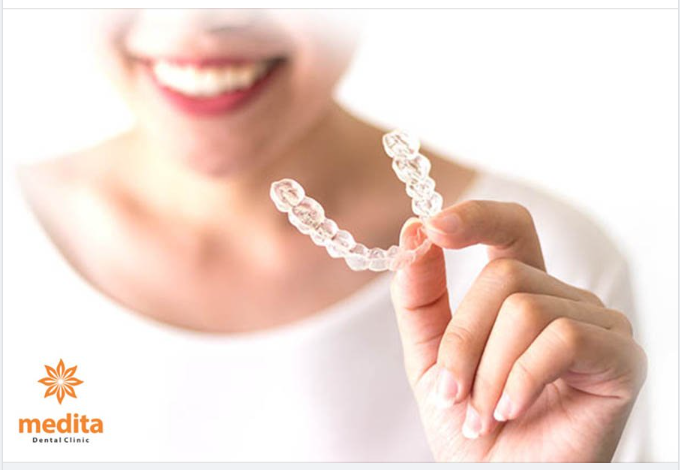 TRƯỜNG HỢP NÀO CÓ THỂ NIỀNG TRONG SUỐT MỘT HÀM?