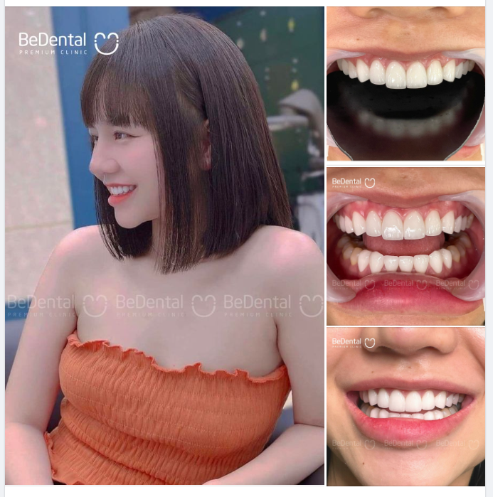  Tự tin cười nói, tạo dáng trước mọi khung hình nhờ thiết kế cung răng tròn đều, hài hòa