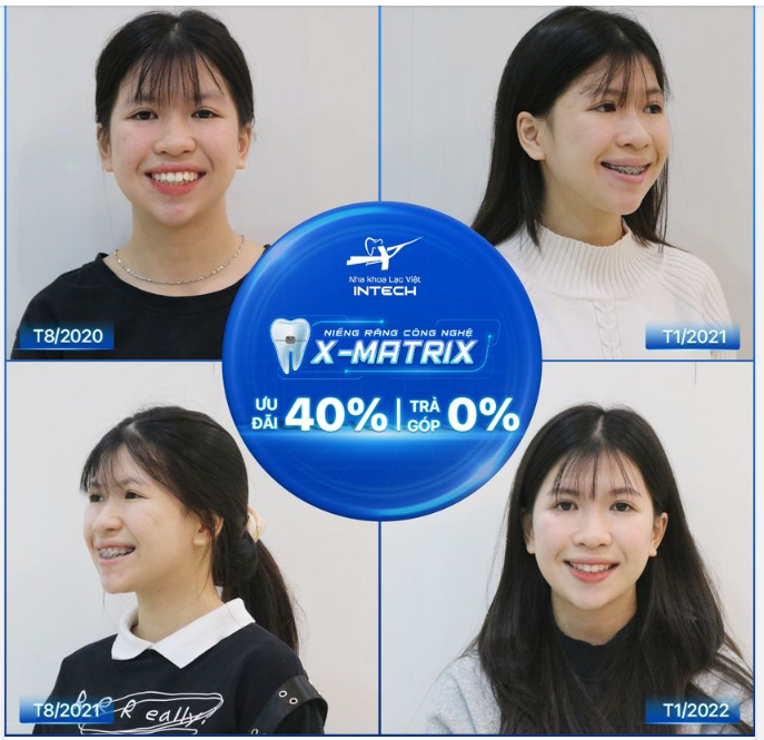 U LÀ TRỜI! Niềng răng có thể thay đổi đến mức này sao!