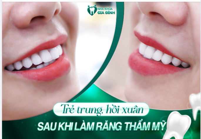 U40, 50 CÓ CẦN THIẾT LÀM RĂNG THẨM MỸ KHÔNG?
