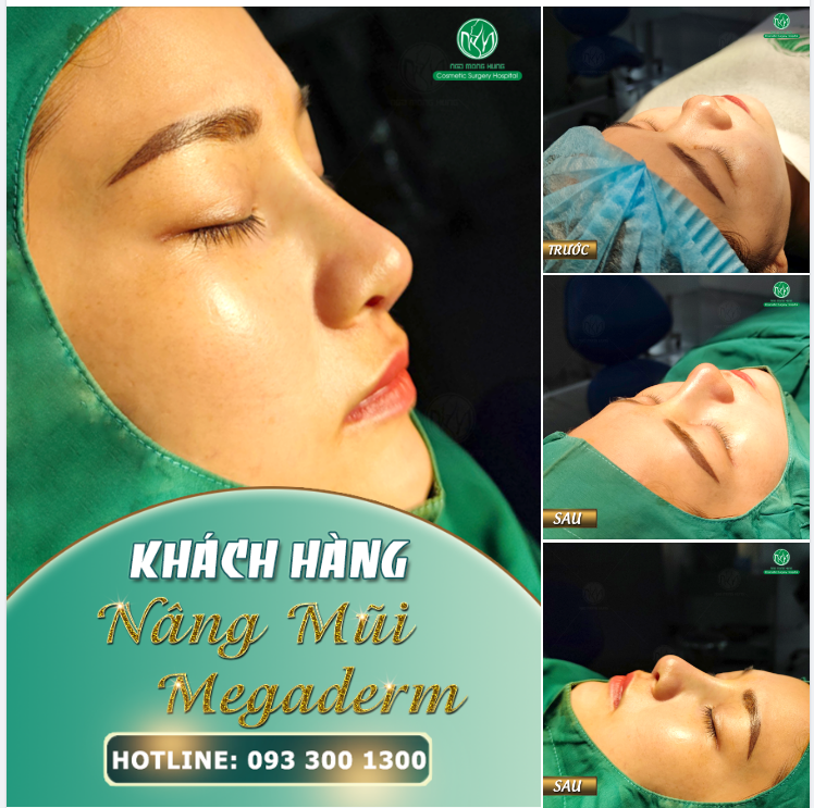 ƯU ĐÃI NÂNG MŨI MEGADERM CHỈ 12,5 TRIỆU ĐỒNG
