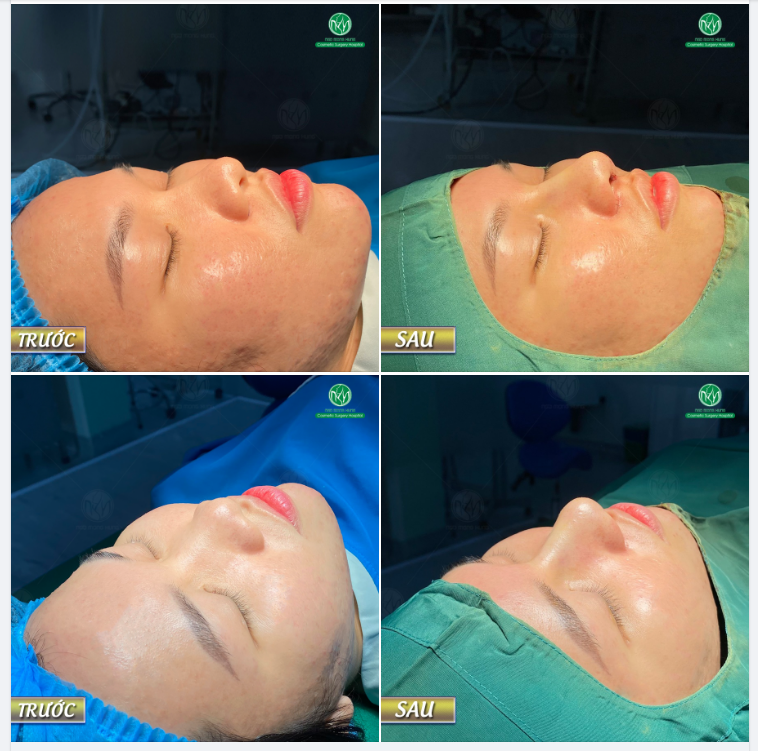 ƯU ĐÃI NÂNG MŨI MEGADERM CHỈ 12,5 TRIỆU ĐỒNG