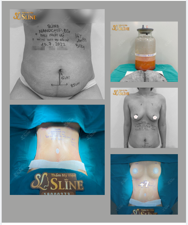 VASERLIPO kết hợp cùng EKIP SLINE