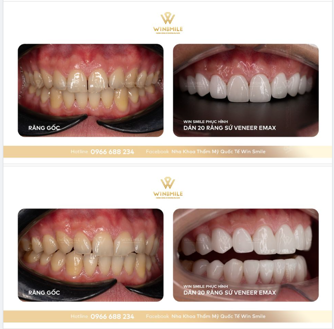 VENEER EMAX – “CÔ NÀNG” MỎNG MANH NHƯNG ĐẦY SỨC HÚT