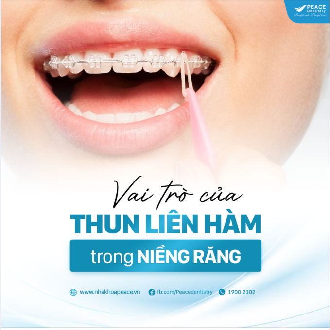 VÌ SAO CẦN ĐEO THUN LIÊN HÀM KHI NIỀNG RĂNG