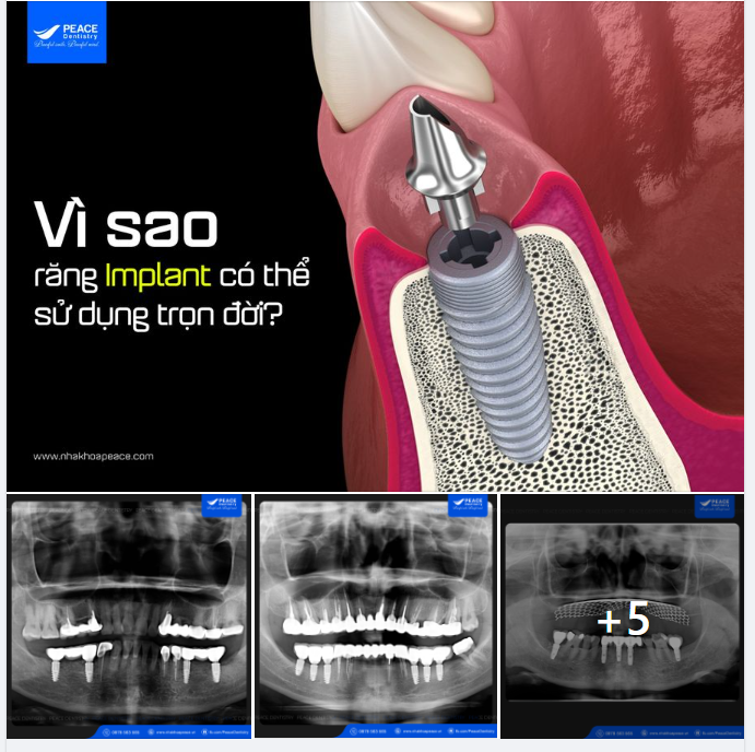 VÌ SAO "RĂNG IMPLANT" CÓ THỂ SỬ DỤNG TRỌN ĐỜI?