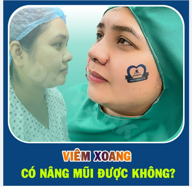 VIÊM XOANG CÓ NÂNG MŨI ĐƯỢC KHÔNG