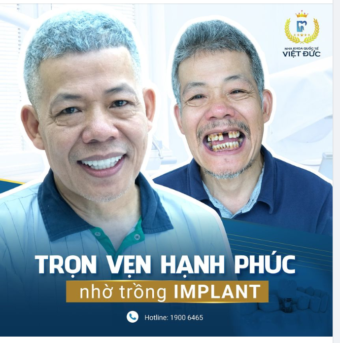 VIỆT KIỀU SÉC VỀ VIỆT NAM TRỒNG RĂNG, CHỈ TRONG VÒNG 1 THÁNG PHỤC HỒI HOÀN TOÀN, ĂN NHAI THOẢI MÁI