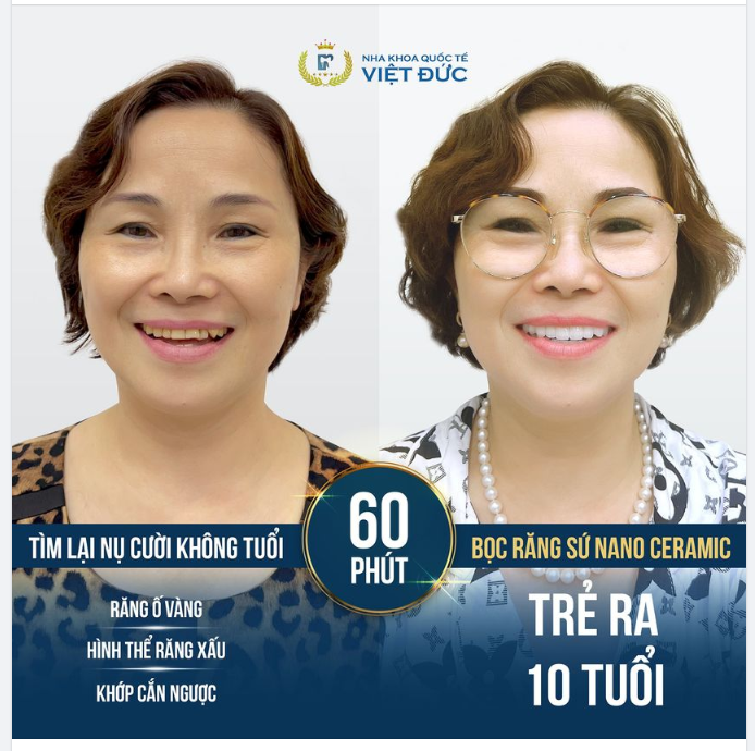 VIỆT KIỀU VỀ VIỆT NAM LÀM RĂNG "QUÁ ƯNG HÀM RĂNG MỚI"