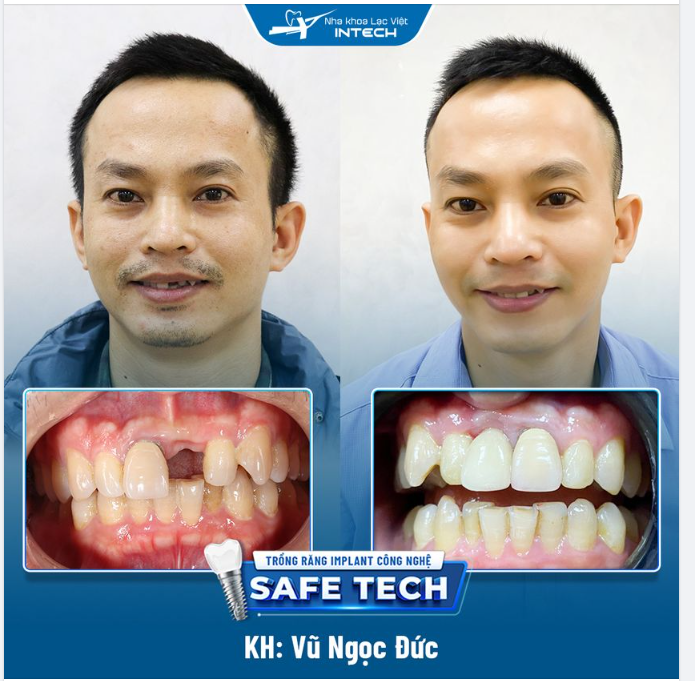 VỘI BỎ CẦU RĂNG SỨ ĐỂ TRỒNG RĂNG IMPLANT BẰNG CÔNG NGHỆ SAFE -TECH