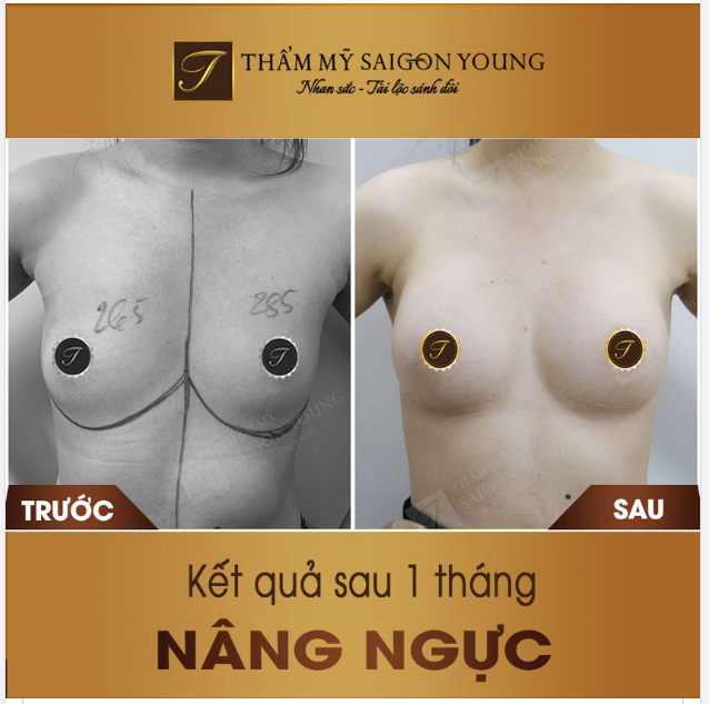 Vòng 1 kém phát triển, không đều nhau, bên to bên nhỏ... khiến chị em mất tự tin về cơ thể của mình.