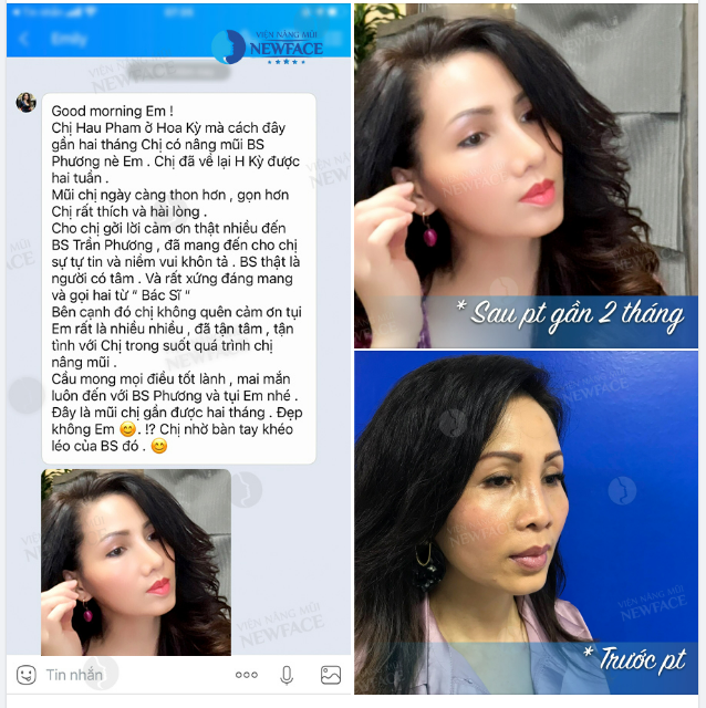Vực Dậy Niềm Tin Từng Sụp Đổ Với NÂNG MŨI SỤN SƯỜN