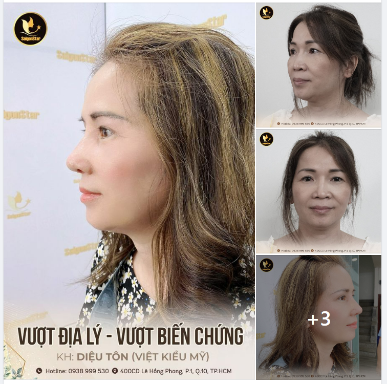 VƯỢT ĐỊA LÝ – VƯỢT BIẾN CHỨNG TÁI TẠO DÁNG MŨI MỚI – KH DIỆU TÔN (VIỆT KIỀU MỸ)