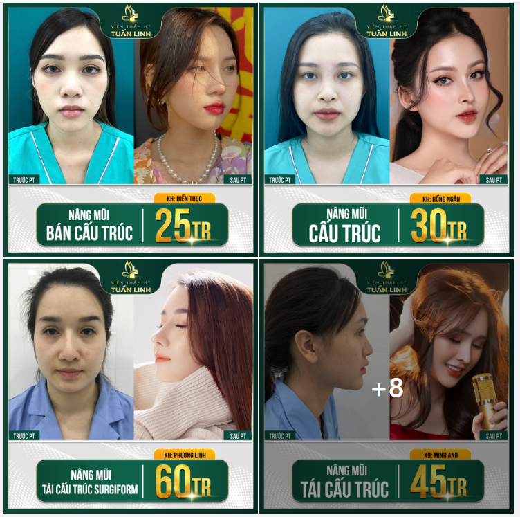 XINH ĐẸP TỎA SÁNG CÙNG DÁNG MŨI XINH