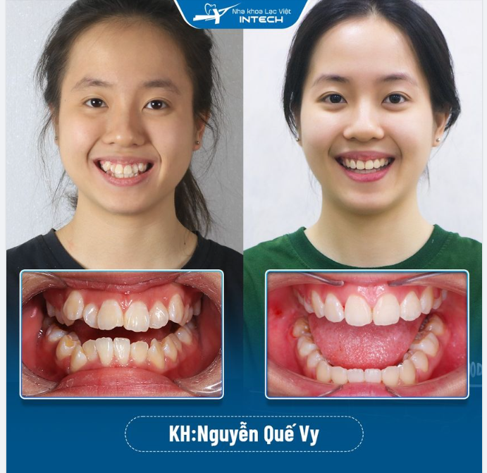 XÓA BỎ CHEN CHÚC - TỰ TIN HƠN VỚI NIỀNG RĂNG X-MATRIX