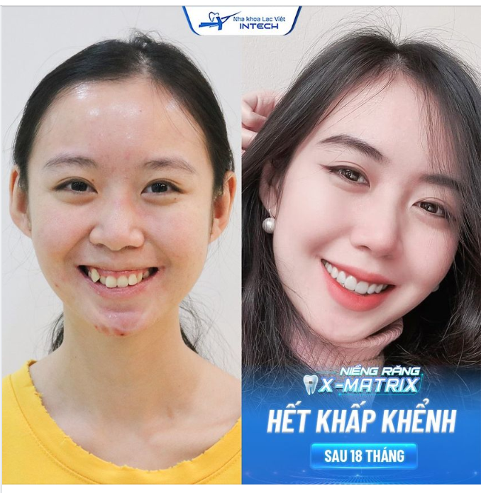 "Xóa bỏ" khấp khểnh, cười hở lợi với niềng răng X-Matrix