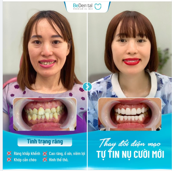 Xử lý khớp cắn chéo không xâm lấn tủy răng