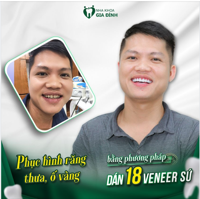 XỬ LÝ RĂNG THƯA, Ô VÀNG VỪA ĐẢM BẢO TÍNH THẨM MỸ, VỪA KHÔNG MÀI NHỎ RĂNG