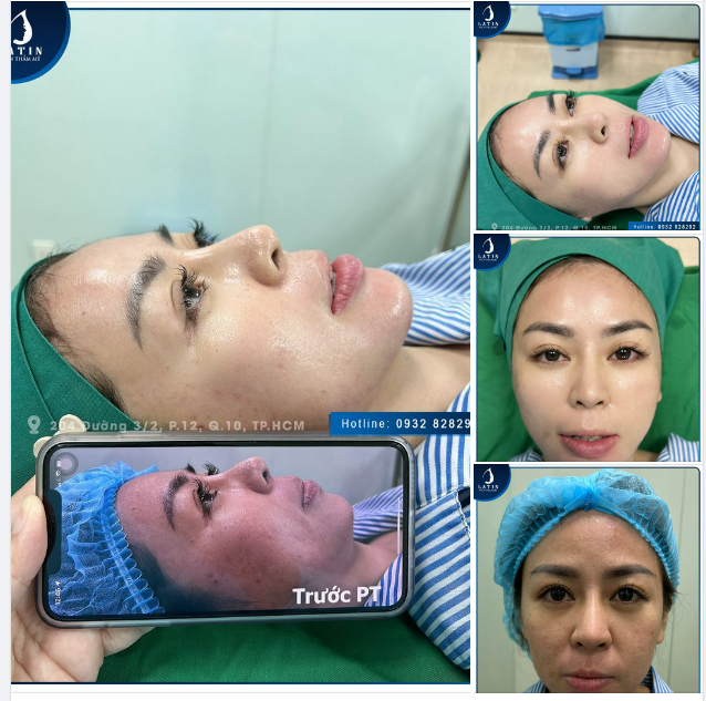 Xử lý thành công ca độn cằm, thay đổi tỉ lệ, chỉnh trục mặt xử lí lệch cho khách hàng