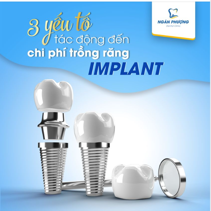 Yếu tố tác động đến chi phí trồng răng Implant 