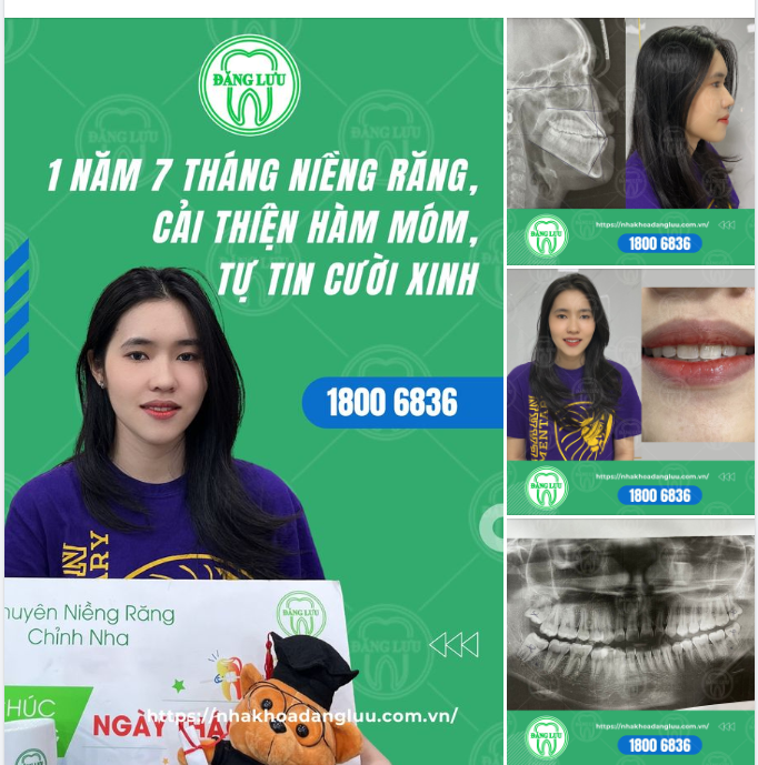 1 NĂM 7 THÁNG NIỀNG RĂNG.