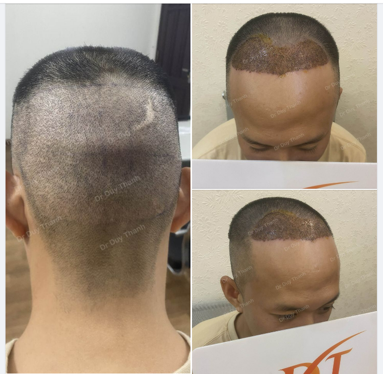 2 NGÀY SAU CẤY TÓC SẼ NHƯ THẾ NÀO