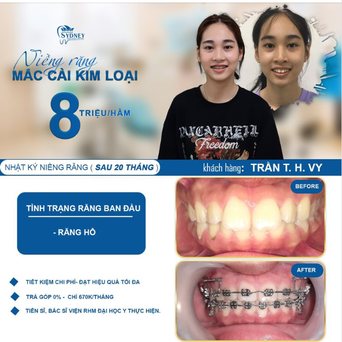 20 THÁNG NIỀNG RĂNG ĐIỀU TRỊ RĂNG HÔ, KẾT QUẢ CÓ KHIẾN BẠN BẤT NGỜ?