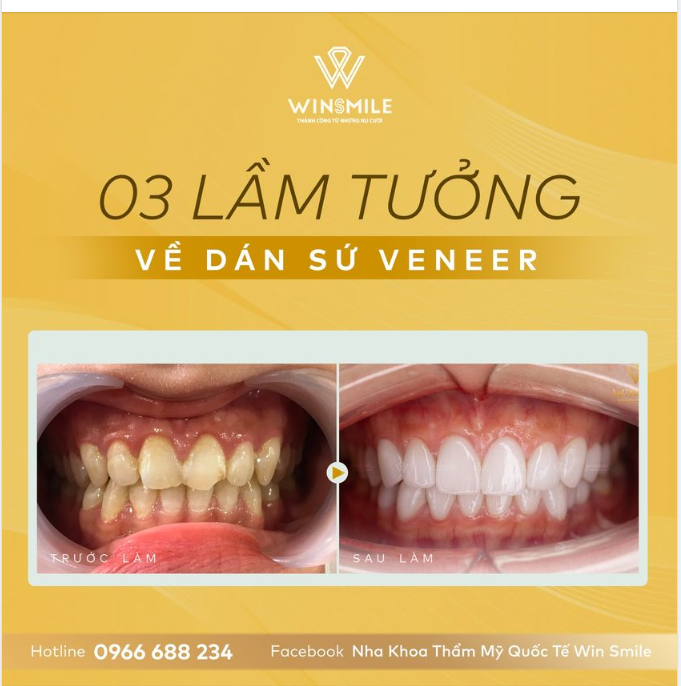 3 LẦM TƯỞNG VỀ DÁN SỨ VENEER KHÔNG THỂ BỎ QUA