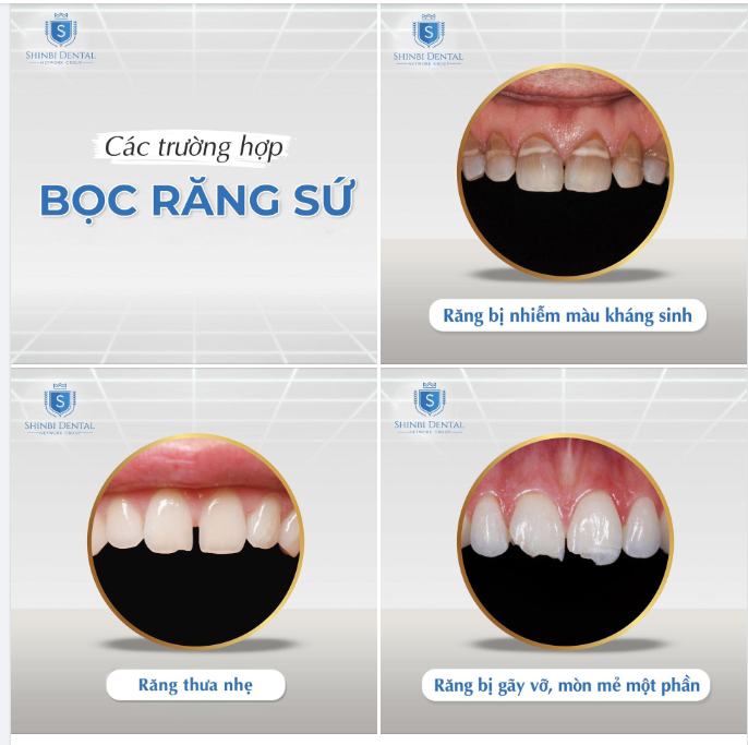 3 TRƯỜNG HỢP PHÁT HUY TÁC DỤNG “THẦN THÁNH” VỚI BỌC RĂNG SỨ THẨM MỸ