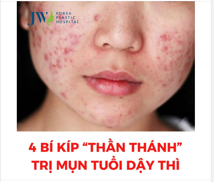 4 BÍ KÍP “THẦN THÁNH” TRỊ MỤN TUỔI DẬY THÌ HIỆU QUẢ NHẤT