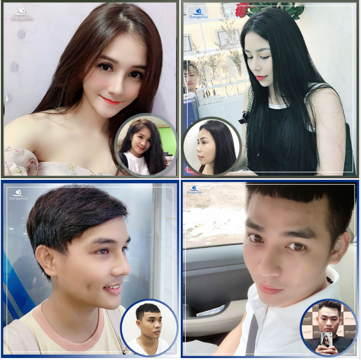 5 ĐIỀU CẤM KỊ KHI NÂNG MŨI BẠN CẦN BIẾT