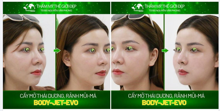 5 Ưu điểm có thể kể đến của phương pháp làm đẹp bằng cấy mỡ tự thân với công nghệ Body- Jet- Evo