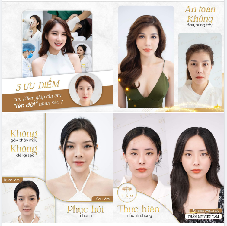 5 ưu điểm của filler giúp chị em “lên đời” nhan sắc