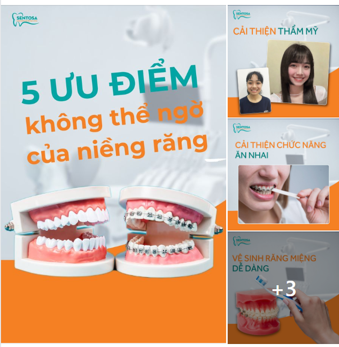 5 ƯU ĐIỂM VƯỢT TRỘI CỦA NIỀNG RĂNG