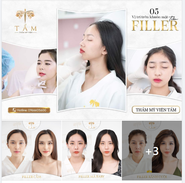 5 Vị Trí Tiêm Filler giúp chị em cải thiện nhan sắc