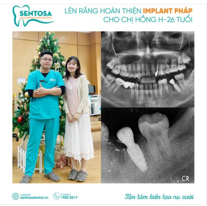Ăn ngon hơn – Cười đẹp hơn – Không còn sợ răng bị di chuyển….