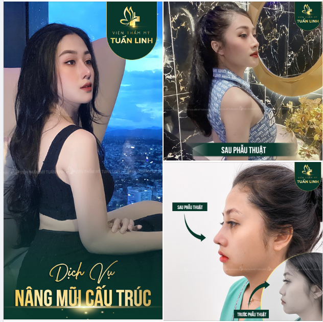 ANGEL LINE CAO TÂY - Dáng mũi thanh tú chuẩn hot girl