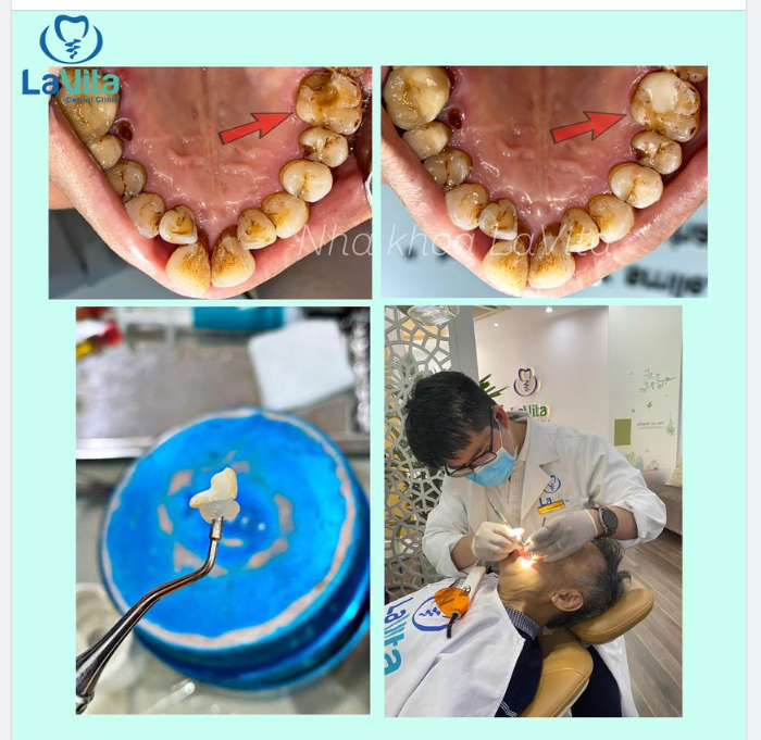 Bác khách hàng ngày hôm nay đến với Nha khoa Lavita trong tình trạng răng hàm trên bị vỡ lớn, thường xuyên giắt thức ăn gây cảm giác vô cùng khó chịu.