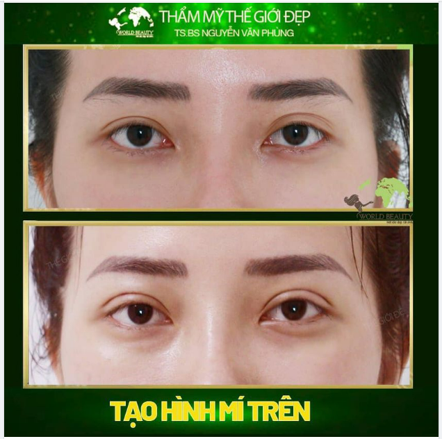 Bấm mí 1 lần - Sở hữu cửa sổ tâm hồn đẹp trọn đời tại sao không 