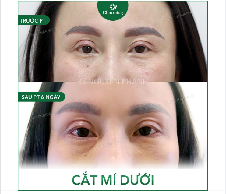 Bạn đã thấy những trường hợp cắt mí trên rồi nhưng trông đôi mắt vẫn không tươi tắn chưa