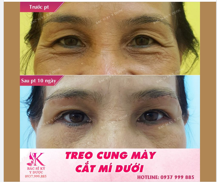 Bạn đang có quầng thâm dưới mắt trong nhiều thập kỷ.