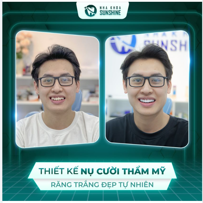 Bạn khách hàng đến với Sunshine với tình trạng: răng khấp khểnh, ố vàng, đường cười không tự nhiên.